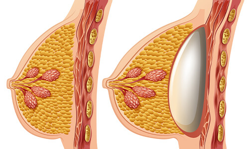 Augmentation mammaire par prothèses